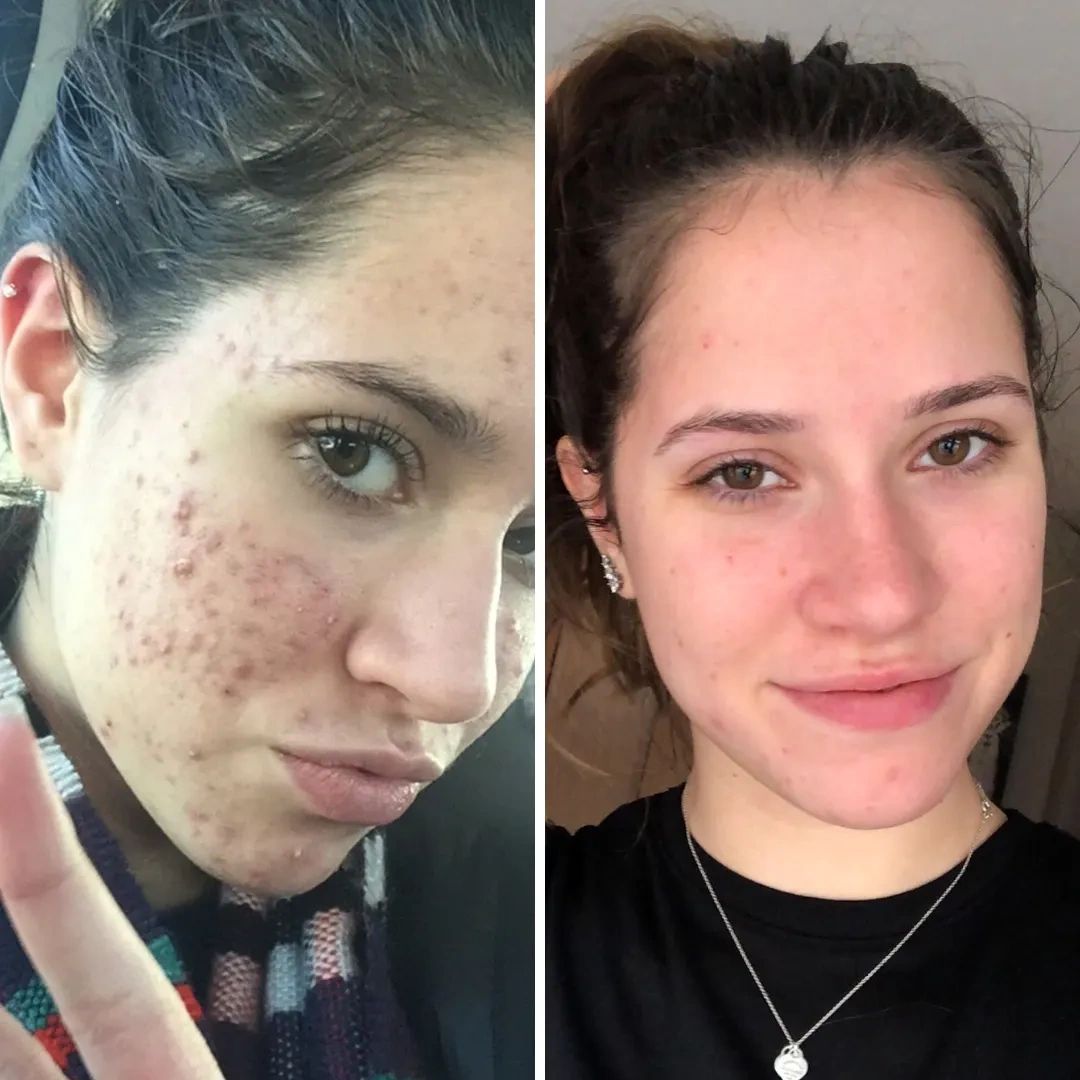 Treatment result