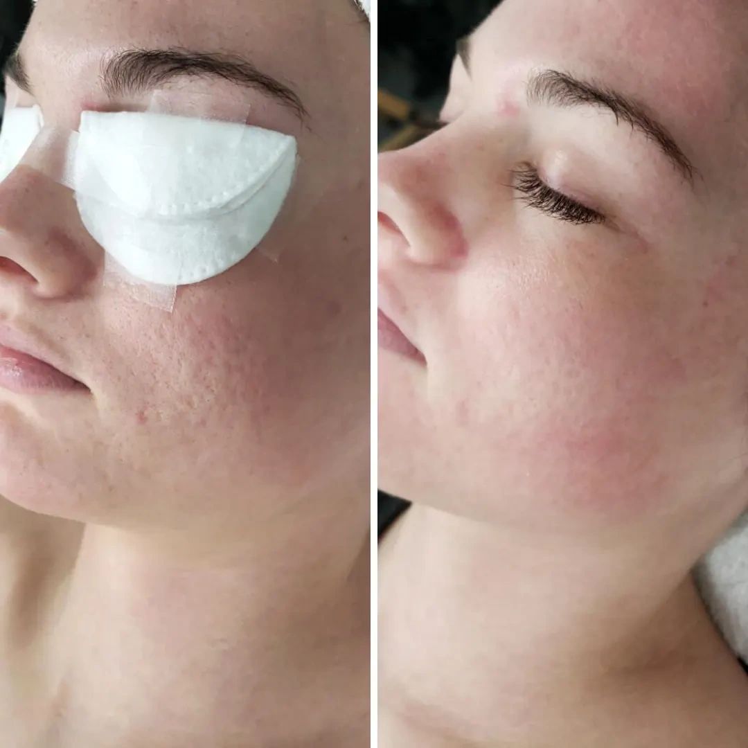 Treatment result